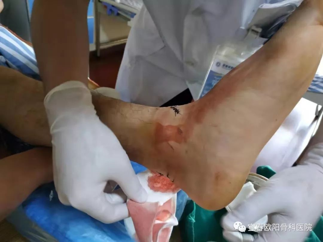 少年脚跟被玻璃割裂，手足外科医师紧急手术