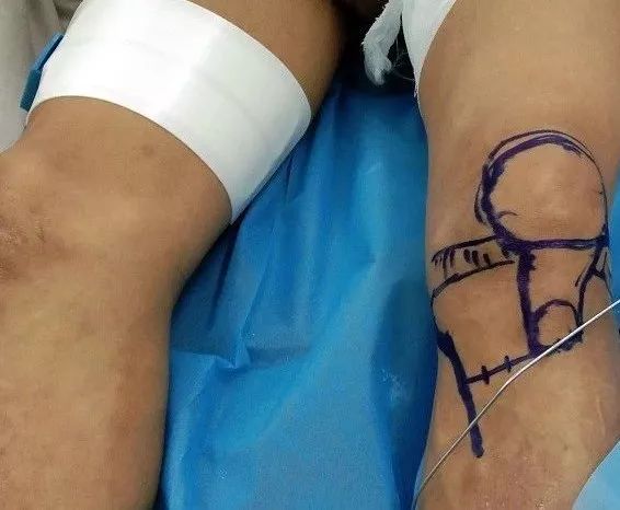我院保膝治疗又获成功，关节病患者的福音！